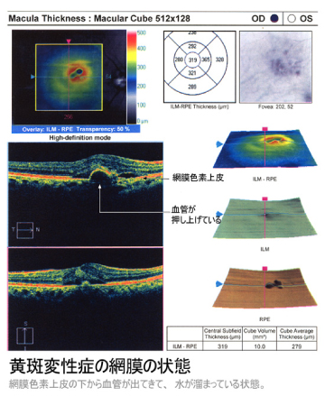 黄斑変性の網膜写真